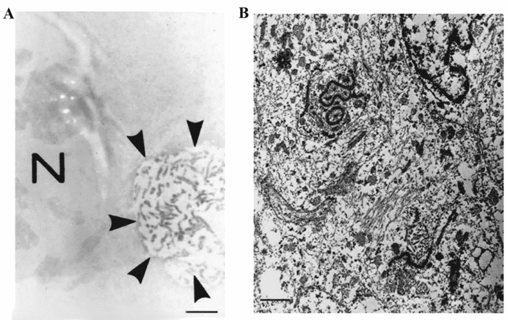 Diagnosis of ependymoma. (A) Immunoelectron micrograph shows immunoreactivity in an intracytoplasmic lumen containing many microvilli (arrowheads). N, nucleus. Bar 1 µm. (B) Electron micrograph of a clear cell ependymoma shows junctional devices and microvilli. Bar 1 µm.
