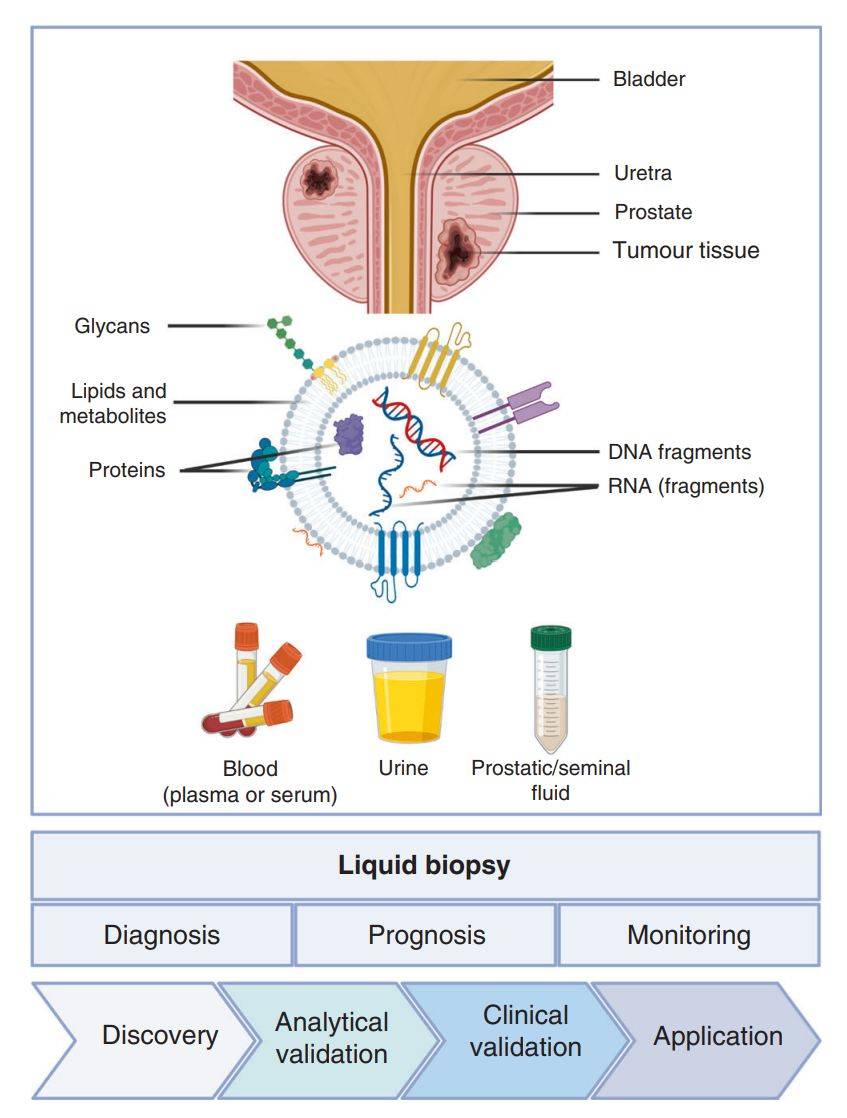 Figure 4. Exosomes as biomarkers for prostate cancer.