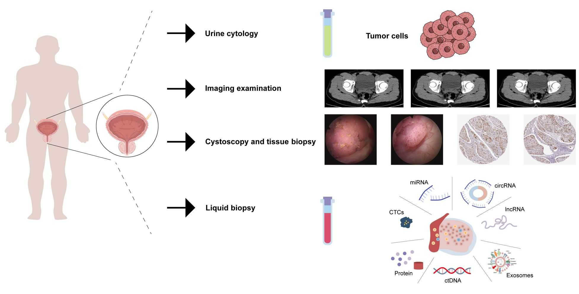 Figure 2. The role of exosomes in prostate cancer progression.